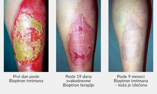 Zepter-Bioptron-wounds